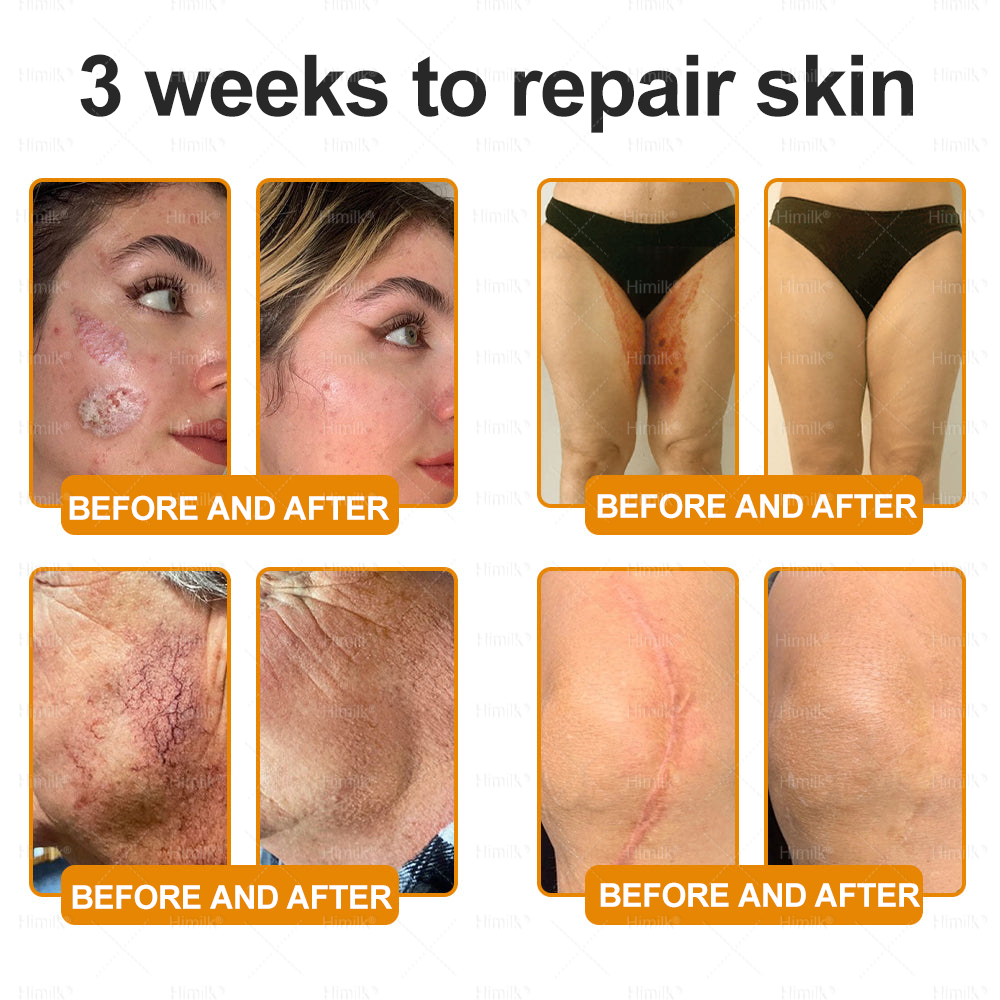 𝑯𝙞𝒎𝙞𝙡𝒌® ---Only 10 jars! Grab an exclusive 30% discount now! Keep your skin youthful and glowing in just 1 to 3 weeks. Don’t miss your chance—this offer won’t come around again until next year. Act fast! 180-day money back guarantee!🔥