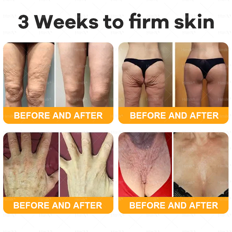 𝑯𝙞𝒎𝙞𝙡𝒌® ---Only 10 jars! Grab an exclusive 30% discount now! Keep your skin youthful and glowing in just 1 to 3 weeks. Don’t miss your chance—this offer won’t come around again until next year. Act fast! 180-day money back guarantee!🔥