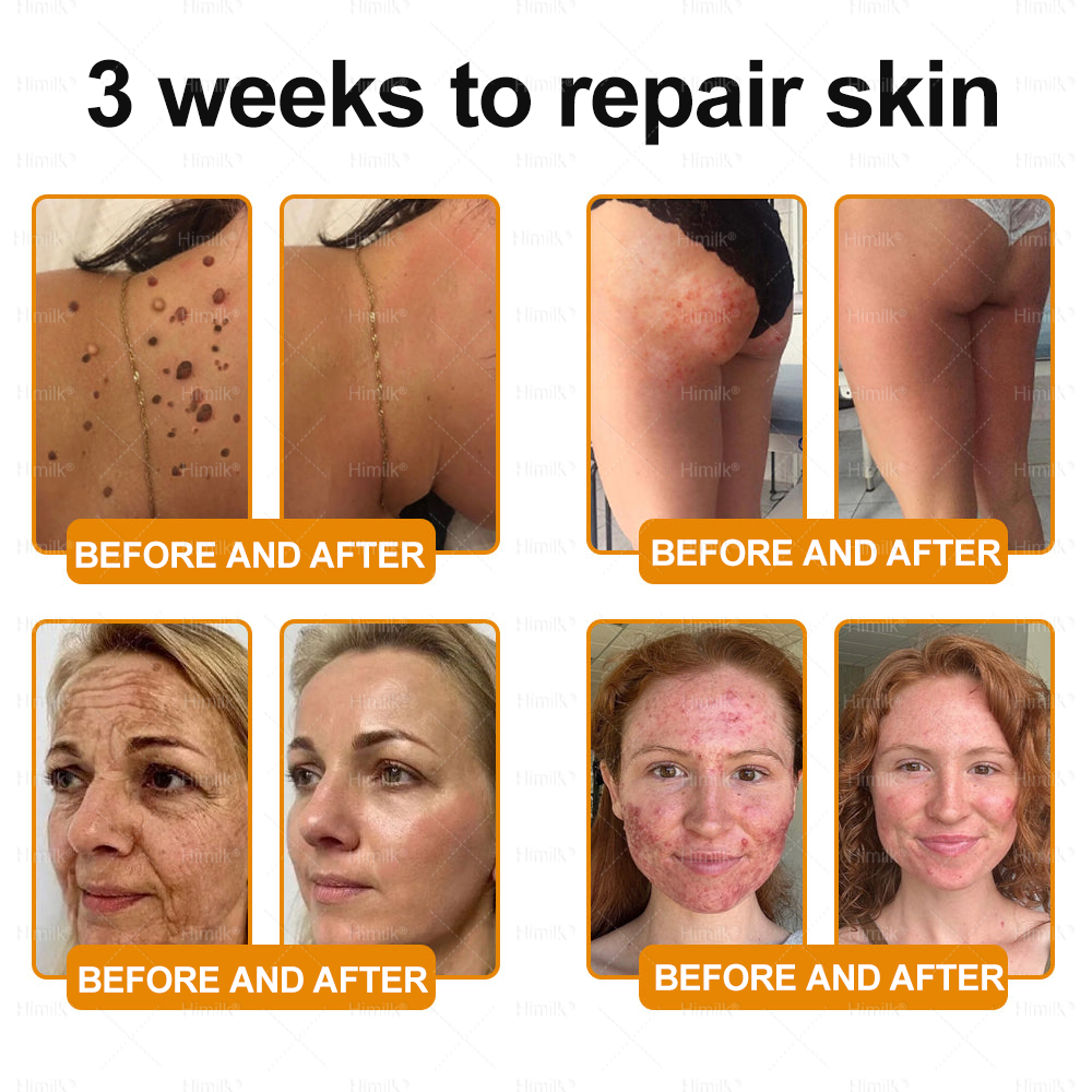 𝑯𝙞𝒎𝙞𝙡𝒌® ---Only 10 jars! Grab an exclusive 30% discount now! Keep your skin youthful and glowing in just 1 to 3 weeks. Don’t miss your chance—this offer won’t come around again until next year. Act fast! 180-day money back guarantee!🔥